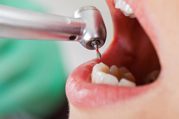 Best Broken or Chipped Tooth Repair in Boynton Beach, FL